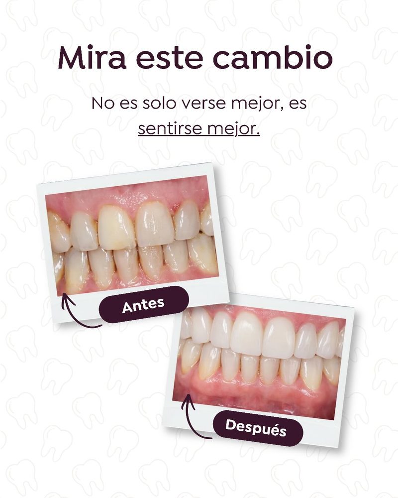 Antes y después de un diseño de sonrisa: una sonrisa alineada y natural