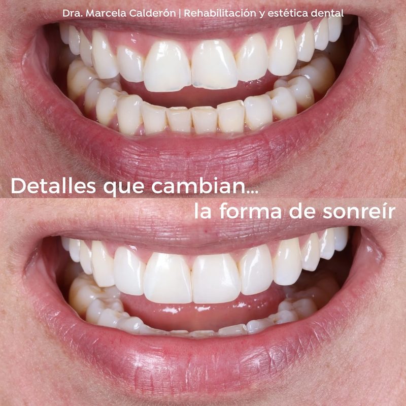 Antes y después de una rehabilitación oral: detalles que cambian la forma de sonreír