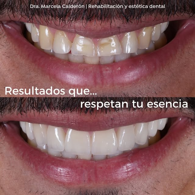Antes y después de una rehabilitación oral: sonrisa natural y armónica